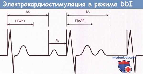 Электрокардиостимуляция (ЭКС) в режиме DDI