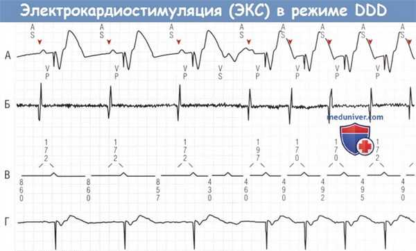 Электрокардиостимуляция в режиме DDD