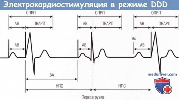 Электрокардиостимуляция в режиме DDD