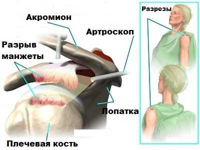 Разрыв манжеты, артроскопия