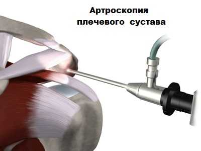 Артроскопия плечевого сустава