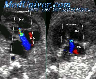 перерыв дуги аорты