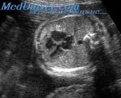 стеноз аорты плода