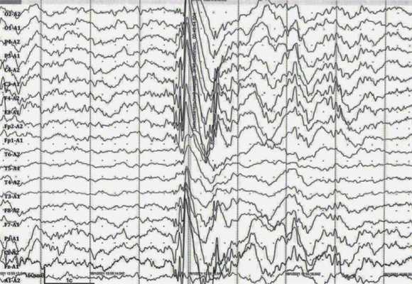 ЭЭГ с эпилептической активностью