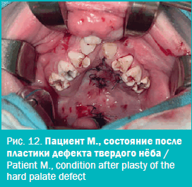 Пациент М., состояние после пластики дефекта твердого нёба