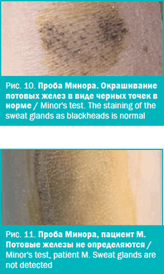 Проба Минора. Окрашивание потовых желез в виде черных точек в норме