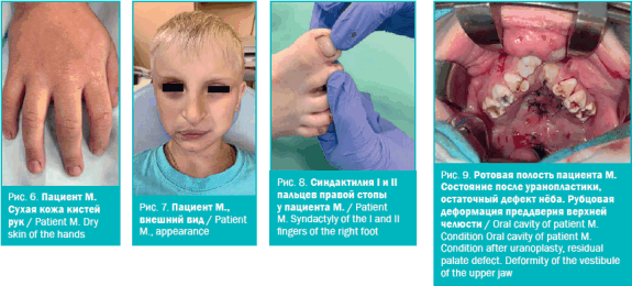 Пациент М. Сухая кожа кистей рук