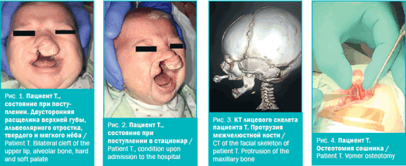 Расщелины губы и нёба как предикторы синдрома EEC: клиническое наблюдение
