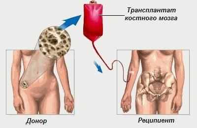 Пересадка костного мозга