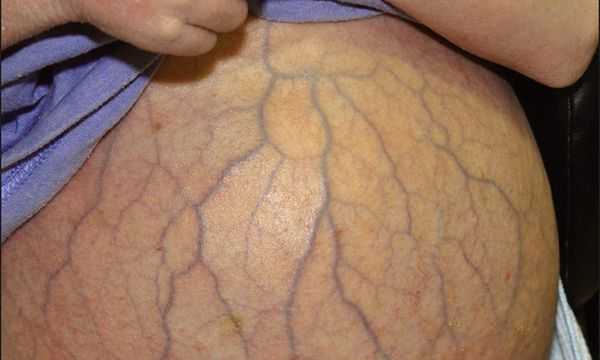 Синдром «Голова медузы»