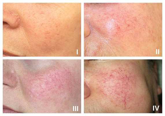Стадии купероза, связанные с розацеа