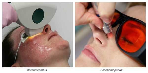 Фото- и лазеротерапия