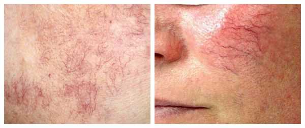 Признаки прогрессирования купероза