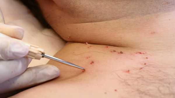 Оперативное удаление папиллом