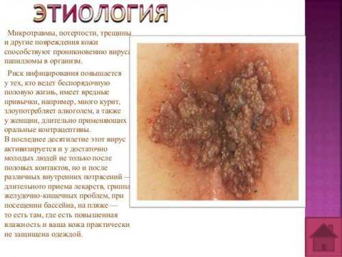 Этиология папиллом