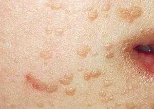 Плоские папилломы