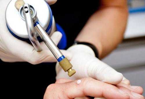 Криотерапия. Процесс удаления папилломы