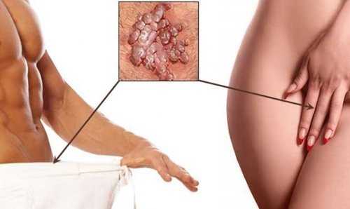 Как лечить кондиломы