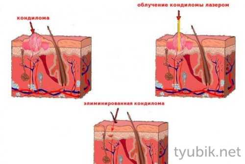 Оперативное удаление кондилом