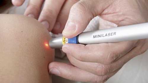 Процесс удаления папиллом с помощью лазерной коагуляции