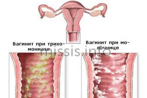 Что такое вагинит