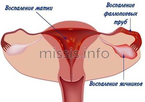 Воспаление половой системы у женщины