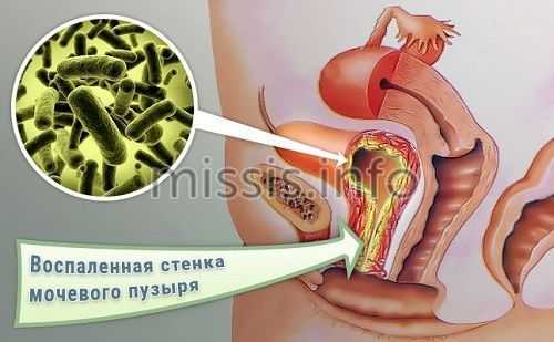 Проникновение бактерий в мочевой пузырь