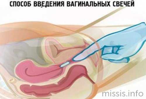 Введение вагинальной свечи