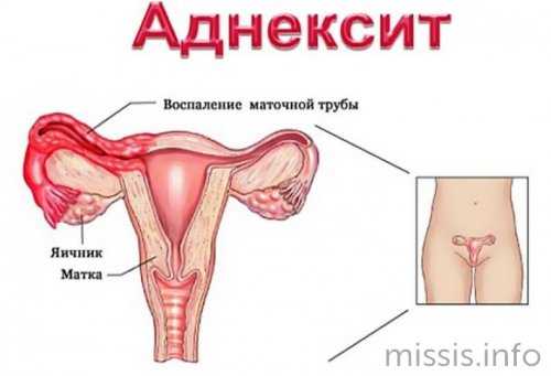 Аднексит у женщины