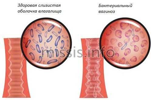 Бактериальный вагиноз влагалища
