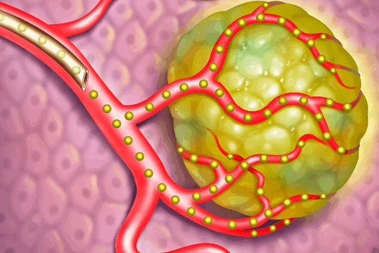 Эмболизация при раке