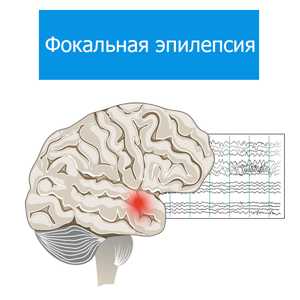 Фокальная эпилепсия