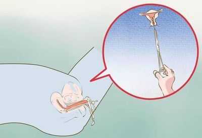 Удаление ВМС