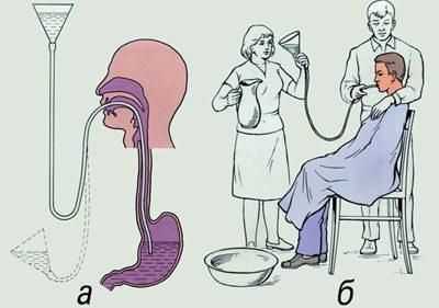 Промывание желудка через зонд