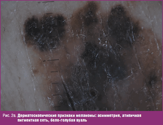 Дерматоскопические признаки меланомы