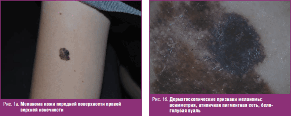 Меланома кожи передней поверхности правой верхней конечности