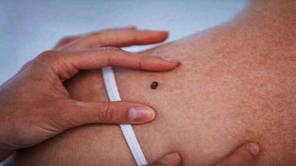 симптомы рака кожи