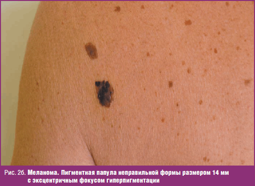 Меланома. Пигментная папула неправильной формы размером 14 мм