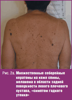 Множественные себорейные кератомы на коже спины, меланома в области задней поверхности левого плечевого сустава