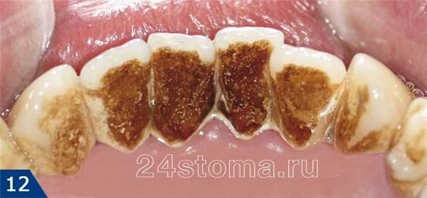 Вид зубов до их очистки Air Flow (большое количество пигментного зубного налета)