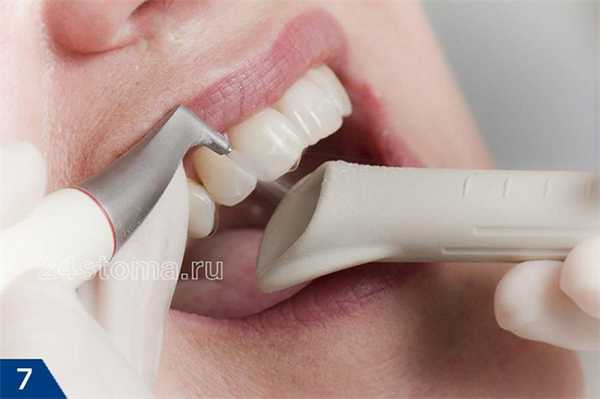 Полировка зубов при помощи Air Flow