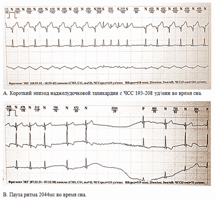  Особенности функционирования сердечно-сосудистой системы у недоношенных детей различных сроков гестации и возможности их выявления в раннем адаптационном периоде 
