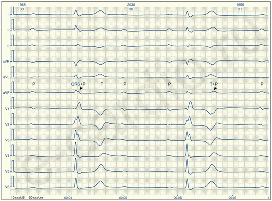 Полная АВ блокада
