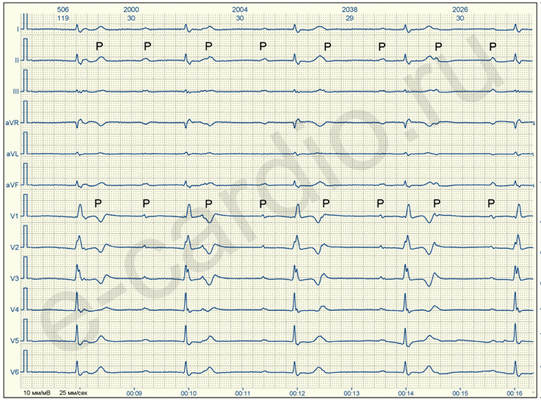 Полная АВ блокада