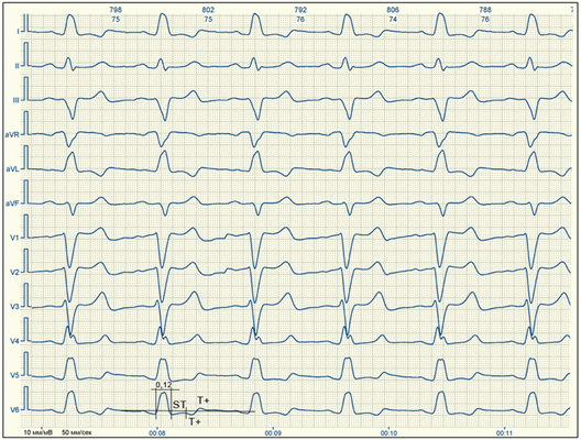 Блокада левой ножки Пучка Гиса