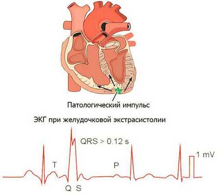 Желудочковая экстрасистолия