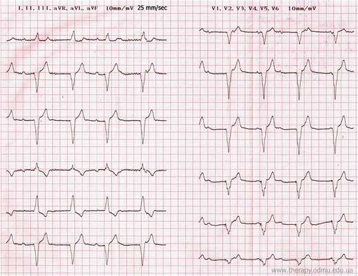 single chamber pacing bipolar