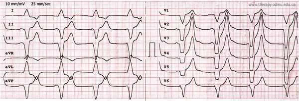 single chamber pacing bipolar filtered