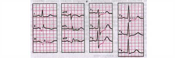Заднедиафрагмальный инфаркт миокарда на ЭКГ