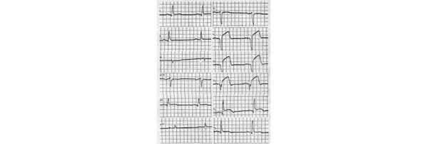 Инфаркт миокарда передней стенки ЛЖ на ЭКГ
